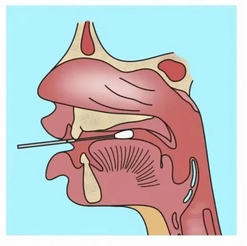 鼻咽拭子采集解剖图图片